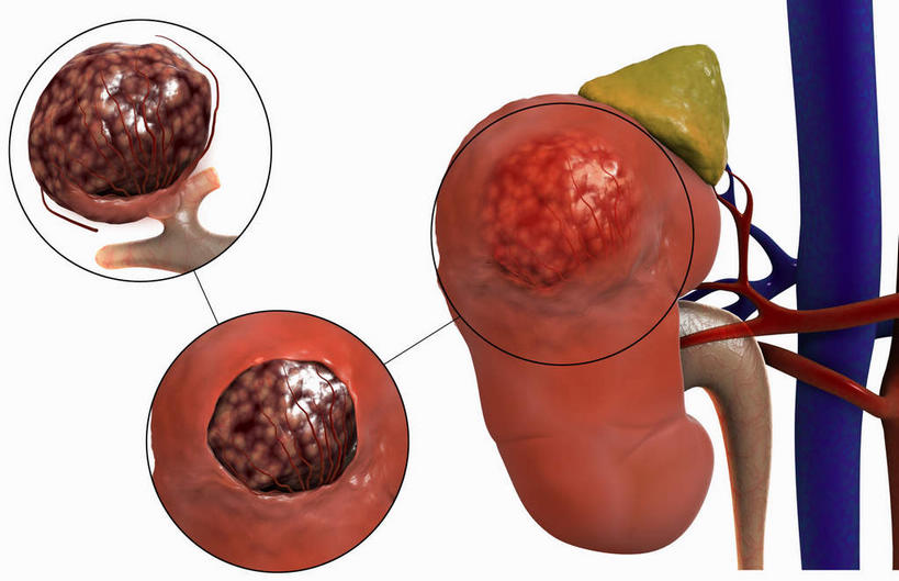 内脏,肾脏,动脉,静脉,无人,横图,插画,室内,白天,白色背景,正面,数码,科技,静物,阴影,网络,医学,标志,符号,高光,几何,计算机图形,合成,图画,标记,画,红色,模型,生病,人体,电脑合成图,数码合成图,生物学,人体器官,器官,肿瘤,漫画,泌尿系统,腺体,生理学,写实,具体,具象,肾上腺,彩图