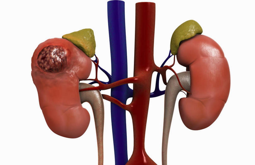 内脏,肾脏,动脉,静脉,无人,横图,插画,室内,白天,白色背景,正面,数码,科技,静物,阴影,网络,医学,高光,几何,计算机图形,合成,图画,画,红色,模型,生病,人体,电脑合成图,数码合成图,生物学,人体器官,器官,肿瘤,漫画,泌尿系统,腺体,生理学,写实,具体,具象,肾上腺,彩图