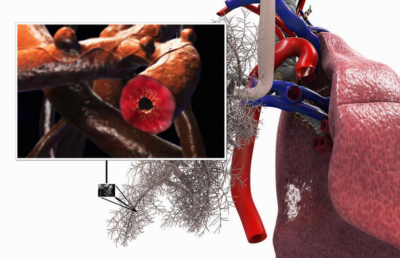 内脏,肺,动脉,静脉,无人,横图,插画,室内,白天,白色背景,正面,数码,科技,静物,阴影,网络,医学,高光,几何,计算机图形,合成,图画,画,红色,模型,人体,电脑合成图,数码合成图,疾病,生物学,人体器官,器官,哮喘,漫画,呼吸道,支气管,生理学,写实,具体,具象,呼吸系统,肺部,肺脏,彩图