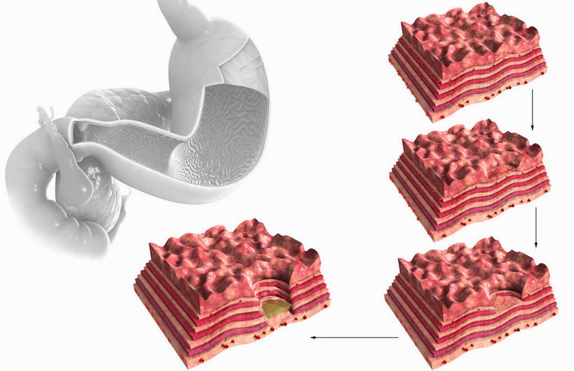 腹部,内脏,胃,动脉,静脉,无人,横图,插画,室内,白天,白色背景,正面,数码,科技,静物,一排,许多,阴影,整齐,网络,医学,高光,几何,计算机图形,合成,图画,画,排列,红色,模型,人体,电脑合成图,数码合成图,生物学,人体器官,器官,队列,漫画,生理学,写实,具体,具象,溃疡,胃部,彩图,胃溃疡