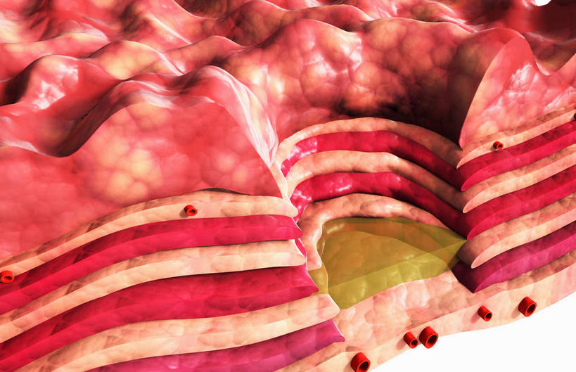 腹部,内脏,胃,动脉,静脉,无人,横图,插画,室内,白天,白色背景,正面,数码,科技,静物,阴影,网络,医学,高光,几何,计算机图形,合成,图画,画,红色,模型,人体,电脑合成图,数码合成图,疾病,生物学,人体器官,器官,漫画,生理学,写实,具体,具象,溃疡,胃部,彩图