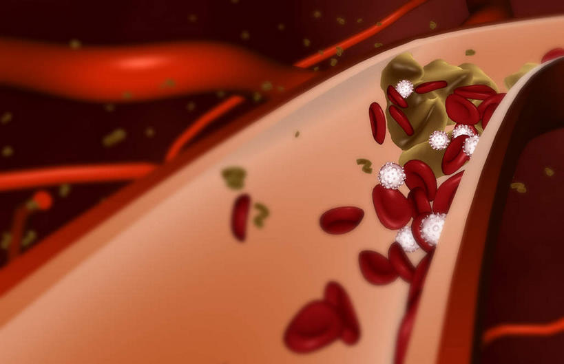 动脉,无人,横图,插画,室内,特写,白天,白色背景,正面,数码,科技,阴影,网络,医学,高光,几何,计算机图形,合成,图画,画,血液,电脑合成图,数码合成图,疾病,生物学,漫画,生理学,写实,具体,具象,动脉硬化,动脉粥样硬化,血块,动脉管壁,彩图,血管壁