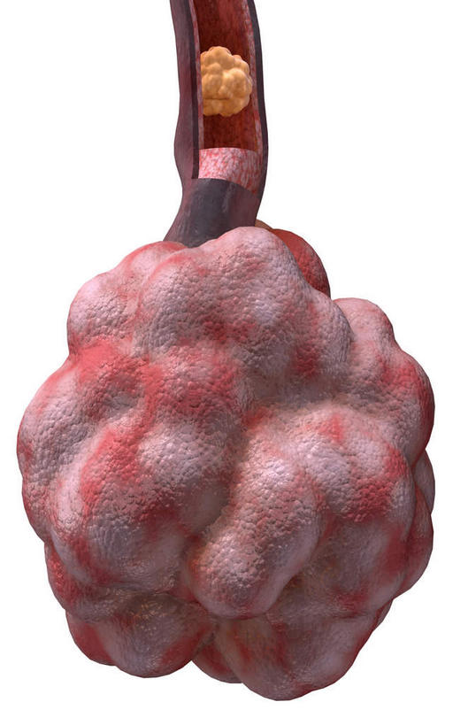 无人,竖图,插画,室内,白天,白色背景,正面,数码,科技,静物,阴影,局部,网络,医学,高光,几何,计算机图形,合成,图画,画,人体,电脑合成图,数码合成图,生物学,漫画,支气管,生理学,写实,具体,具象,细支气管,呼吸系统,肺泡,囊肿性纤维化,彩图