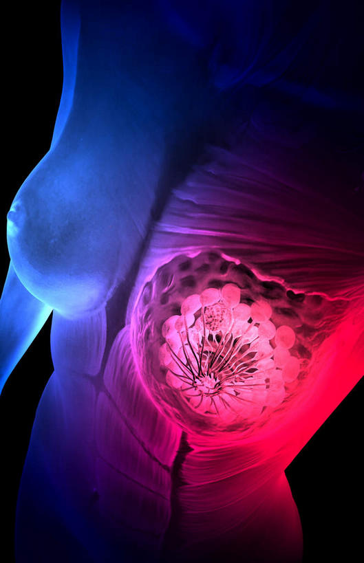 胸,无人,竖图,插画,室内,特写,白天,正面,数码,科技,静物,阴影,黑色背景,网络,医学,高光,几何,计算机图形,合成,图画,画,人体,电脑合成图,数码合成图,生物学,肿瘤,乳腺癌,漫画,癌症,生理学,写实,具体,具象,肿瘤细胞,女性,胸部,彩图