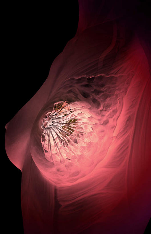 胸,无人,竖图,插画,室内,特写,白天,正面,数码,科技,静物,阴影,黑色背景,网络,医学,高光,几何,计算机图形,合成,图画,画,人体,电脑合成图,数码合成图,生物学,肿瘤,乳腺癌,漫画,癌症,生理学,写实,具体,具象,肿瘤细胞,女性,胸部,彩图