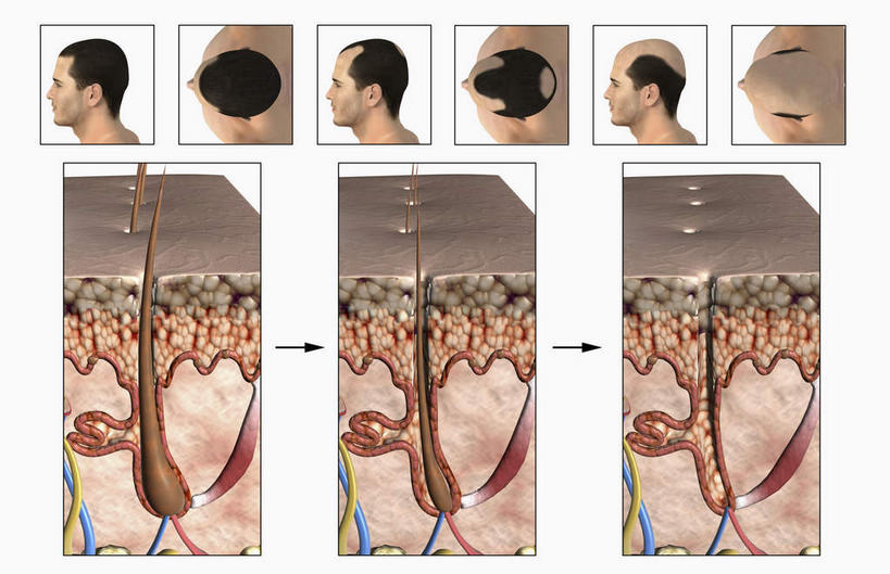 脸,头,脸颊,头发,秃头,无人,横图,插画,室内,特写,白天,白色背景,正面,数码,科技,静物,阴影,网络,医学,高光,几何,计算机图形,合成,图画,画,人体,皮肤,电脑合成图,数码合成图,生物学,漫画,生理学,写实,具体,具象,毛囊,头皮,发根,脱发,头部,光头,脸部,脸蛋,面部,彩图
