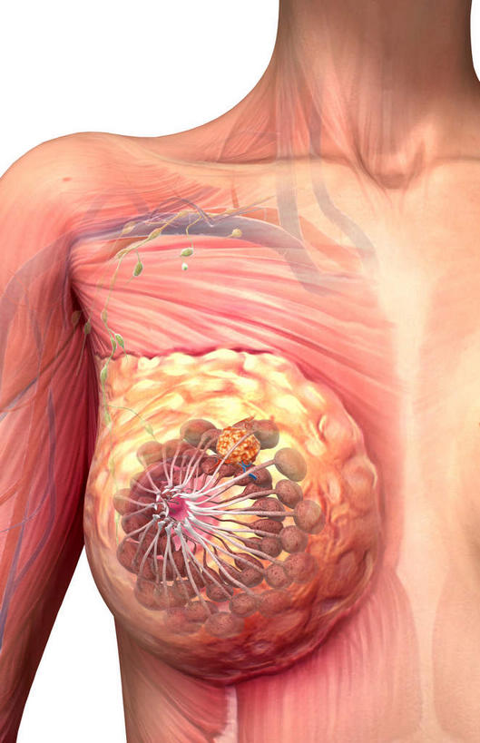 胸,无人,竖图,插画,室内,特写,白天,白色背景,正面,数码,科技,静物,阴影,网络,医学,高光,几何,计算机图形,合成,图画,画,人体,电脑合成图,数码合成图,生物学,肿瘤,乳腺癌,漫画,癌症,生理学,写实,具体,具象,肿瘤细胞,女性,胸部,彩图