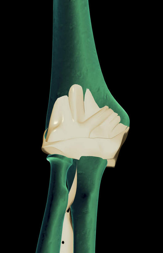 无人,横图,插画,x光片,室内,白天,正面,数码,科技,阴影,黑色背景,发光,辐射,科学,网络,医学,高光,几何,计算机图形,合成,图画,画,绿色,皮肤,电脑合成图,数码合成图,医疗,科学技术,x射线,x光,韧带,漫画,写实,具体,具象,肘部,彩图,电磁波,电磁辐射