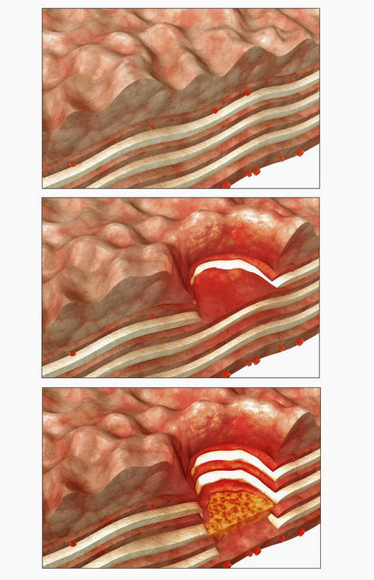 内脏,肠,动脉,静脉,十二指肠,无人,竖图,插画,室内,白天,白色背景,正面,数码,科技,静物,阴影,网络,医学,高光,几何,计算机图形,合成,图画,画,模型,人体,电脑合成图,数码合成图,生物学,人体器官,器官,漫画,生理学,写实,具体,具象,溃疡,大肠,盲肠,小肠,直肠,彩图