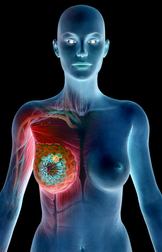 胸,无人,竖图,插画,x光片,室内,特写,白天,正面,数码,科技,静物,阴影,黑色背景,辐射,科学,网络,医学,细胞,高光,几何,计算机图形,合成,图画,画,红色,蓝色,人体,电脑合成图,数码合成图,医疗,生物学,科学技术,x射线,乳腺癌,x光,漫画,癌症,癌细胞,生理学,写实,具体,具象,乳腺,胸部,半身,彩图,电磁波,电磁辐射