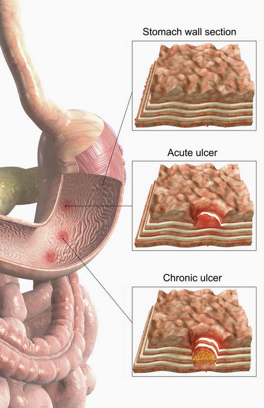 腹部,内脏,胃,动脉,静脉,无人,竖图,室内,白天,白色背景,正面,数码,科技,静物,阴影,过程,网络,医学,英文,标志,文字,字符,字母,高光,几何,计算机图形,合成,标识,模型,人体,英文字母,电脑合成图,数码合成图,生物学,人体器官,器官,生理学,写实,具体,具象,溃烂,胃部,彩图