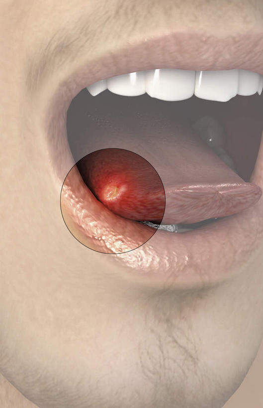 西方人,嘴,内脏,动脉,静脉,胡须,一个人,无人,竖图,插画,室内,特写,白天,正面,数码,科技,静物,欧洲,欧洲人,仅一个男性,仅一个人,阴影,网络,医学,高光,几何,计算机图形,合成,图画,画,仅一个年轻男性,红色,模型,张嘴,人体,电脑合成图,数码合成图,疾病,生物学,人体器官,器官,漫画,张大嘴巴,生理学,写实,具体,具象,溃疡,口腔溃疡,男人,男性,年轻男性,白种人,胡子,小胡子,口,口腔,嘴巴,嘴唇,张开嘴,半身,彩图