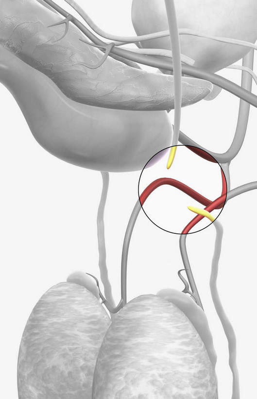 内脏,动脉,静脉,无人,竖图,插画,室内,白天,白色背景,正面,数码,科技,静物,阴影,网络,医学,高光,几何,计算机图形,合成,图画,画,红色,白色,模型,人体,电脑合成图,数码合成图,生物学,人体器官,器官,漫画,生理学,写实,具体,具象,男性生殖器官,输精管,输精管结扎术,彩图