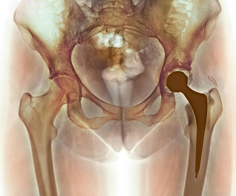 骨骼,骨盆,无人,横图,插画,x光片,室内,白天,正面,数码,科技,阴影,辐射,科学,网络,医学,骨头,高光,几何,计算机图形,合成,图画,画,电脑合成图,数码合成图,骨架,医疗,科学技术,x射线,合成图,x光,漫画,写实,具体,具象,骶骨,髋骨,尾骨,胯骨,关节炎,彩图,电磁波,电磁辐射