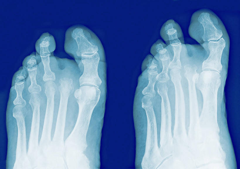 腿部,脚,脚趾,脚趾甲,腿,无人,横图,x光片,室内,特写,白天,正面,静物,阴影,辐射,光线,科学,医学,影子,灯光,医疗,科学技术,x射线,x光,跗骨,趾骨,蹠骨,脚指甲,X光图片,X光图像,彩图,电磁波,电磁辐射