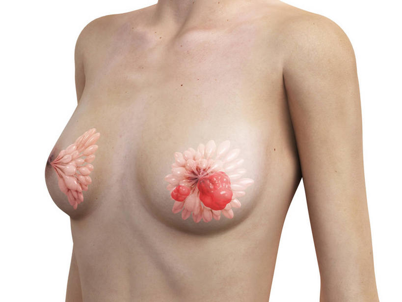 乳房,内脏,动脉,静脉,一个人,无人,站,横图,插画,室内,白天,白色背景,正面,数码,科技,仅一个年轻女性,仅一个女性,仅一个人,阴影,科学,网络,医学,高光,几何,计算机图形,合成,图画,裸露,画,站着,人体,赤裸,电脑合成图,数码合成图,生物学,人体器官,器官,合成图,裸,乳腺癌,漫画,癌症,癌细胞,写实,具体,具象,乳腺,自然科学,博物学,生物科学,年轻女性,女人,女性,站立,半身,彩图