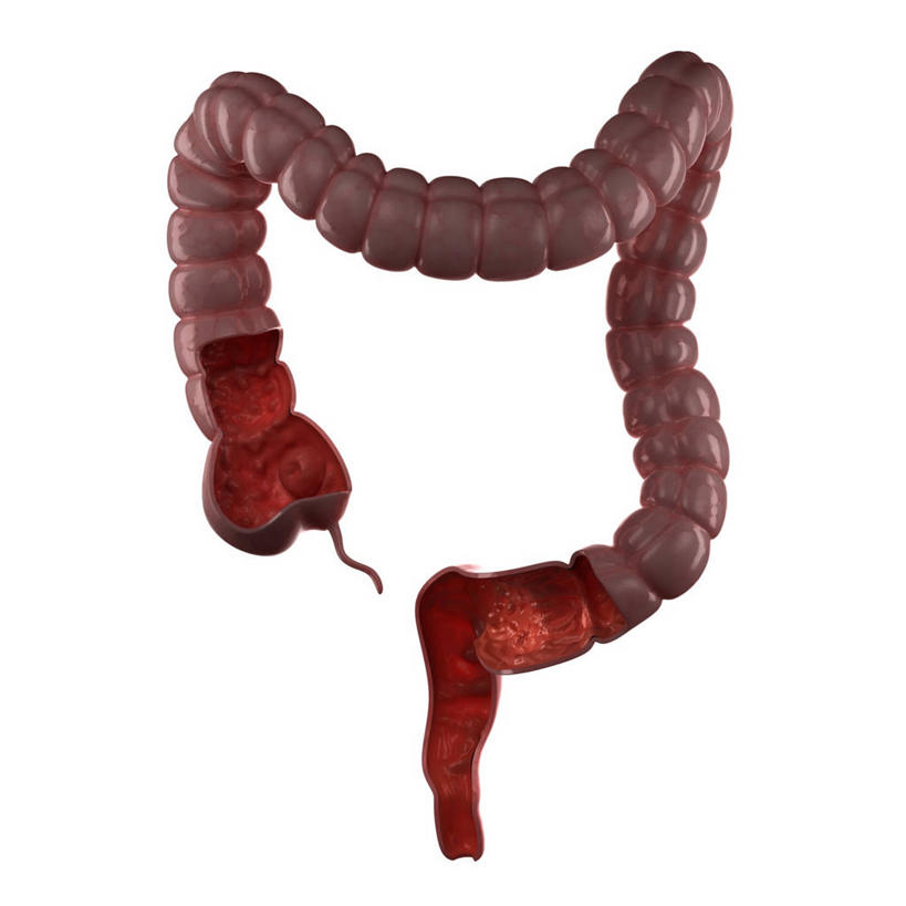 内脏,肠,动脉,静脉,无人,方图,插画,室内,白天,正面,数码,科技,阴影,科学,网络,医学,高光,几何,计算机图形,合成,图画,画,粉色,人体,电脑合成图,数码合成图,疾病,生物学,人体器官,器官,合成图,漫画,写实,具体,具象,结肠,炎症,自然科学,博物学,生物科学,彩图,发炎,结肠炎