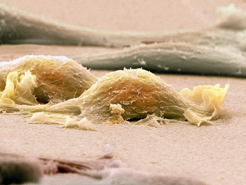 无人,横图,插画,室内,白天,正面,数码,科技,阴影,网络,医学,细胞,高光,几何,计算机图形,合成,图画,画,两个,黄色,生物,纤维,电脑合成图,数码合成图,医疗,生物学,肿瘤,漫画,癌症,生理学,写实,具体,具象,电镜,彩图,肉瘤