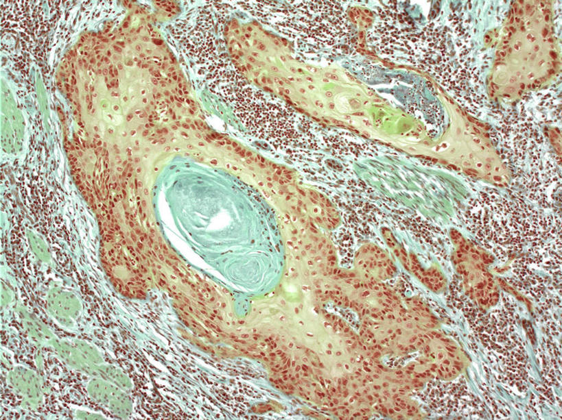 无人,横图,插画,室内,特写,白天,正面,数码,科技,静物,阴影,网络,医学,圆形,细胞,高光,几何,计算机图形,合成,图画,画,人体,电脑合成图,数码合成图,生物学,漫画,癌症,生理学,写实,具体,具象,皮肤癌,彩图