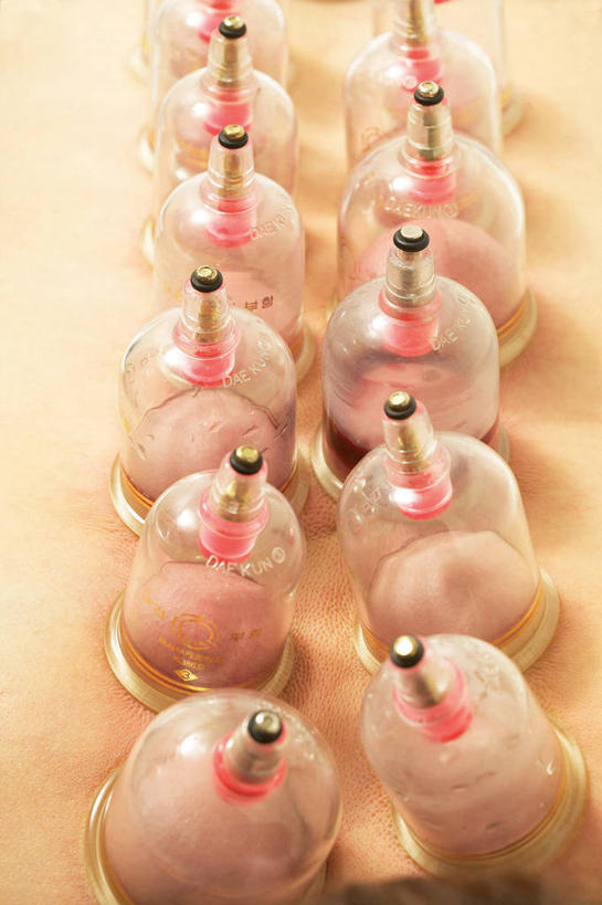 东方人,一个人,竖图,俯视,室内,特写,白天,亚洲,仅一个男性,仅一个人,一排,许多,整齐,并列,并排,医学,很多,黄种人,文化,裸露,排列,仅一个年轻男性,趴着,治疗,保健,医疗,队列,中国文化,裸,平行,拔火罐,中医,火罐,医治,拔罐,拔罐疗法,拔罐子,火罐疗法,中医学,男人,男性,年轻男性,亚洲人,趴,半身,彩图,高角度拍摄,传统文化