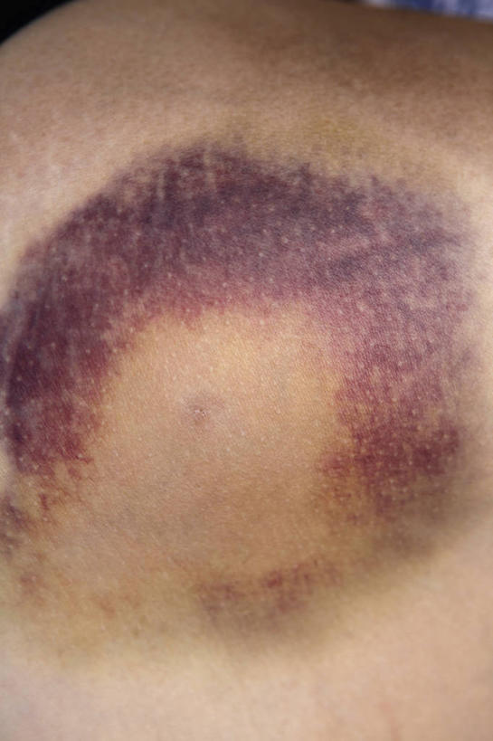 西方人,腿部,腿,一个人,竖图,俯视,室内,特写,白天,欧洲,欧洲人,仅一个年轻女性,仅一个女性,仅一个人,紫色,年轻女性,女人,女性,白种人,半身,彩图,高角度拍摄,瘀伤