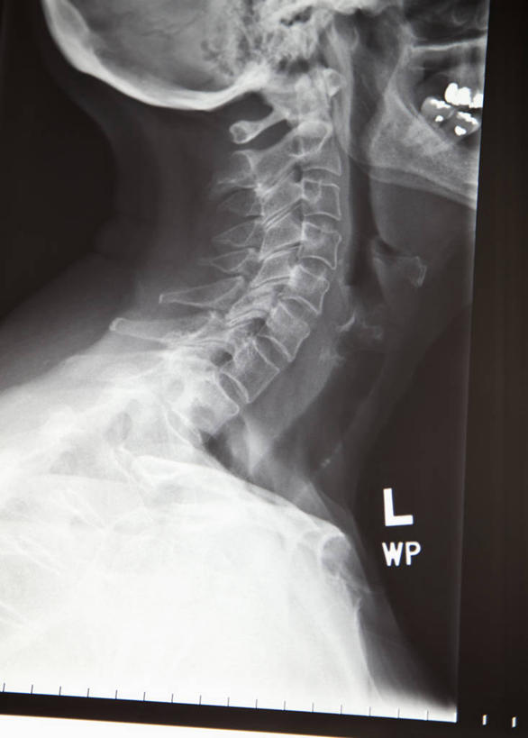 颅骨,无人,竖图,黑白,x光片,室内,特写,白天,正面,静物,辐射,科学,医学,医疗,科学技术,x射线,x光,鼻骨,顶骨,额骨,颈椎,颞骨,下颌骨,颧骨,头盖骨,电磁波,电磁辐射