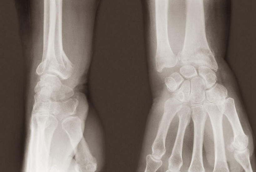 骨骼,无人,横图,x光片,室内,特写,白天,正面,静物,灰色背景,辐射,科学,医学,骨头,两个,骨架,医疗,科学技术,x射线,x光,尺骨,肱骨,桡骨,腕骨,掌骨,指骨,彩图,电磁波,电磁辐射