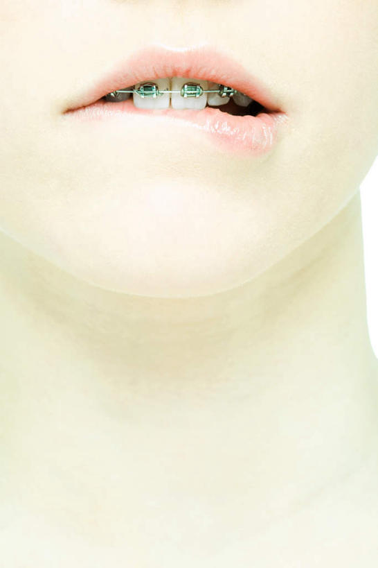 西方人,脸,头,嘴,脸颊,一个人,竖图,室内,特写,白天,白色背景,正面,欧洲,欧洲人,仅一个年轻女性,仅一个女性,仅一个人,模型,鬼脸,摄影,影棚,模具,矫正,牙科,牙套,牙箍,校正,校准,牙饰,年轻女性,女人,女性,白种人,头部,脸部,脸蛋,面部,嘴巴,嘴唇,半身,彩图,影棚拍摄,拍摄