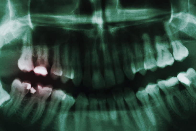 牙齿,无人,横图,x光片,室内,特写,白天,正面,静物,阴影,朦胧,模糊,反射,辐射,科学,医学,影子,医疗,科学技术,x射线,x光,齿,牙,牙龈,彩图,电磁波,电磁辐射