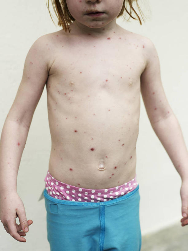 西方人,儿童,一个人,病人,站,竖图,室内,白天,正面,纯洁,欧洲,欧洲人,仅一个女性,仅一个人,阴影,裤子,反射,影子,墙,休闲裤,裸露,墙壁,墙面,小孩,白色,站着,仅一个小孩,可爱,童年,童趣,疾病,病患,裸,童真,烂漫,无邪,传染,传染病,DNA病毒,痘病毒,天花,烈性传染病,天真,女孩,女人,女性,白种人,孩子,患者,就医者,站立,半身,彩图,天花病毒,女生