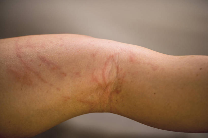 西方人,一个人,横图,特写,欧洲,欧洲人,朦胧,模糊,无脊椎动物,动物,摄影,伤口,暴力,痛苦,受伤,进攻,过敏,损伤,白种人,水母,彩图,挫伤