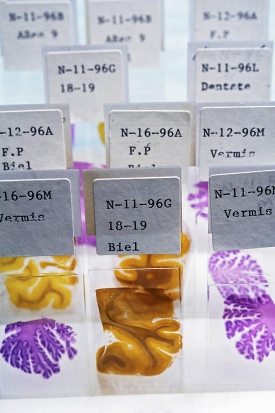 脑,无人,竖图,室内,特写,美国,研究,标签,纸巾,生病,摄影,组织,载玻片,肯塔基州,老年痴呆症,玻片,盖玻片,彩图