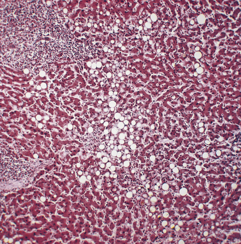 肝脏,无人,竖图,方图,生病,人体,摄影,放大,肝炎,显微图片,彩图,全画面,全框架,全帧,全画幅