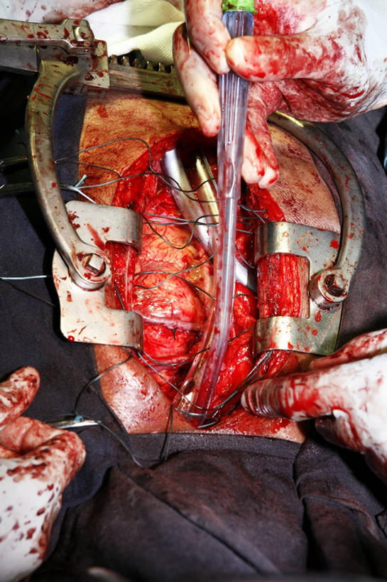 成年人,手,三个人,医生,竖图,俯视,特写,安全,合作,团队,不锈钢,管子,防护,拿着,手套,职业,躯干,血液,摄影,保护,部分,手术,准确,拼接,保险,医疗工具,外科医生,保全,周全,安稳,安定,防护手套,手术器械,平安,胸部,清洗,彩图,高角度拍摄,吸气管