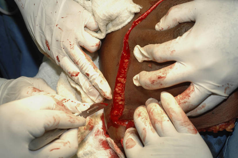 成年人,手,乳房,四个人,横图,室内,安全,防护,手套,血液,摄影,保护,部分,手术,保险,切断,保全,周全,安稳,安定,防护手套,手术剪刀,平安,女人,非洲人,彩图,乳癌