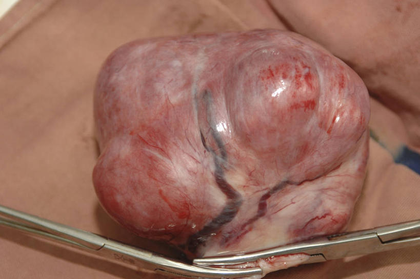 无人,横图,室内,特写,不锈钢,镊子,摄影,部分,手术,手术室,医疗工具,彩图,良性肿瘤