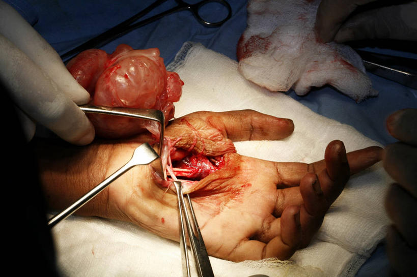 成年人,手,四个人,横图,室内,特写,安全,纱布,防护,骨头,拿着,手套,血液,摄影,保护,部分,手术,伤口,手术室,专心,肿瘤,解剖刀,保险,切断,手术台,医疗工具,外科医生,保全,周全,安稳,安定,防护手套,平安,男人,彩图,神经系统