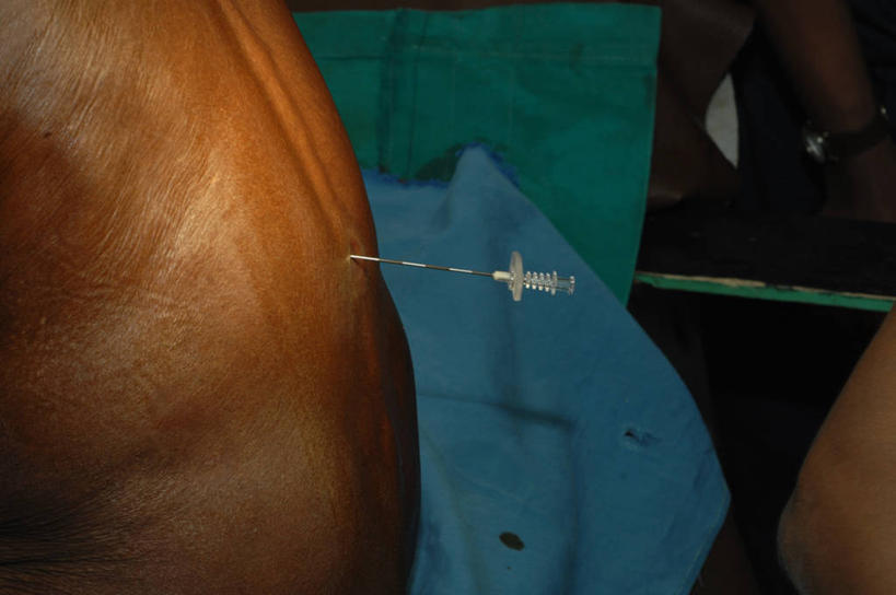 一个人,病人,坐,横图,室内,裸露,背面,摄影,部分,注射器,裸,手术台,麻醉剂,彩图