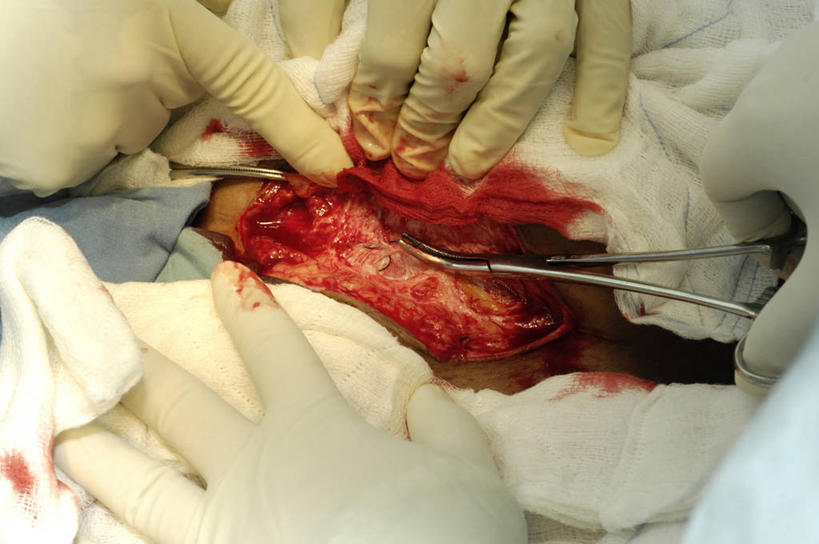 成年人,三个人,横图,俯视,室内,安全,苏丹,纱布,防护,手套,怀孕,血液,摄影,皮肤,保护,部分,手术,分娩,解剖刀,保险,切断,保全,周全,安稳,安定,防护手套,手术剪刀,剖腹产,平安,女人,彩图,高角度拍摄