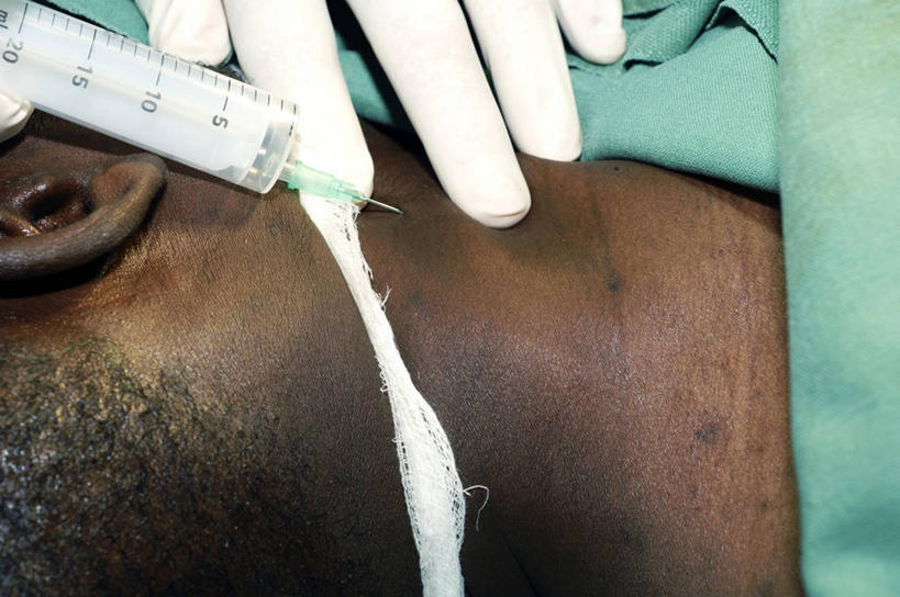 脖子,血管,两个人,横图,俯视,室内,特写,安全,苏丹,防护,拿着,手套,趴着,注射,摄影,保护,部分,手术,手术室,注射器,金属丝,保险,医疗工具,外科医生,保全,周全,安稳,安定,防护手套,颈内静脉,导尿管,平安,彩图,高角度拍摄,手术衣,颈外静脉