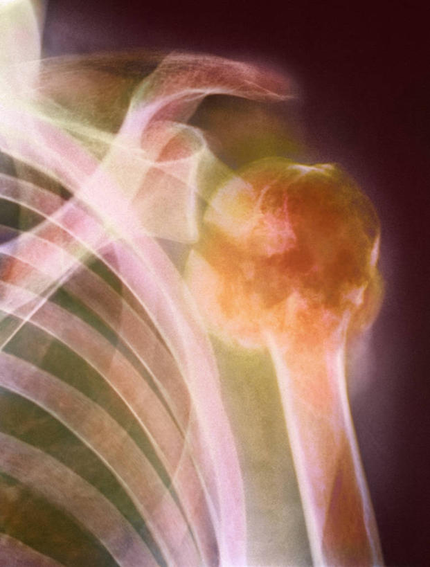 骨骼,无人,竖图,x光片,室内,特写,白天,正面,辐射,科学,医学,骨头,橙色,骨架,医疗,科学技术,x射线,肿瘤,x光,癌症,恶性肿瘤,彩图,电磁波,电磁辐射,多发骨髓瘤,骨髓癌,浆细胞瘤