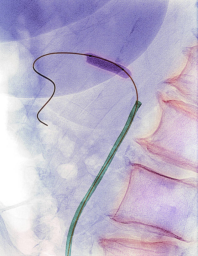 无人,竖图,x光片,室内,特写,白天,正面,技术,辐射,科学,医学,紫色,医疗,科学技术,x射线,化验,诊疗,x光,彩图,电磁波,电磁辐射,穿刺,经皮穿刺术,球囊血管成形术